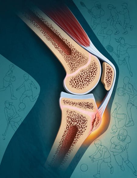 Knie kniecare osgood schlatter joris de wildt