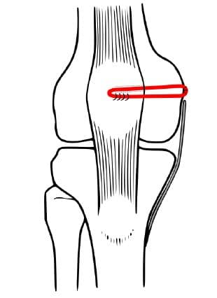 MPFL reconstrucitie Kniecare Nijmegen