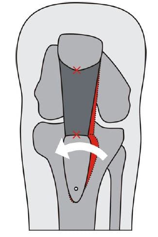 Tuberositas transpositie Kniecare nijmegen