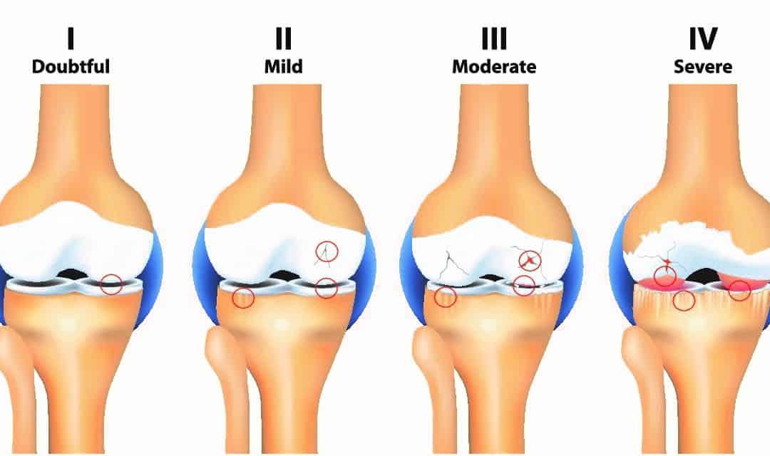 Kraakbeendefect knie